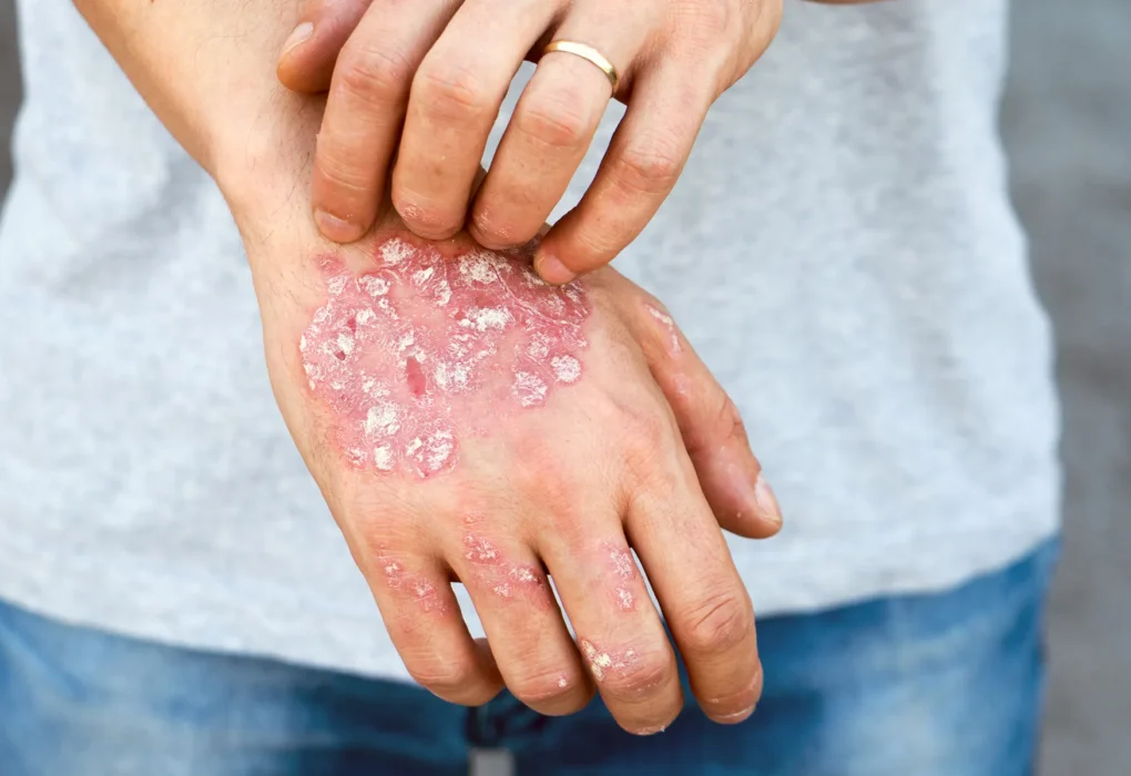 Psoriasis