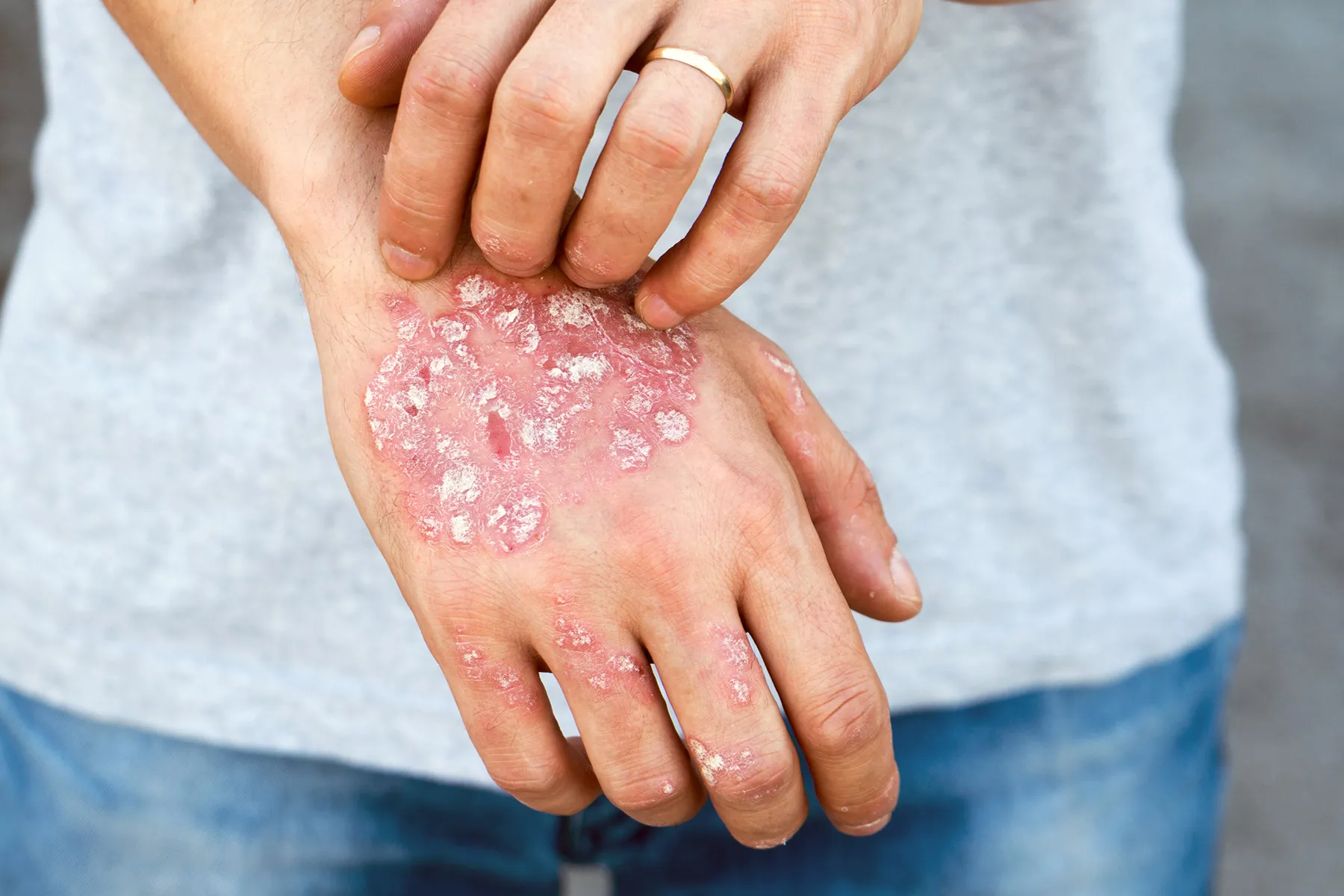 Psoriasis